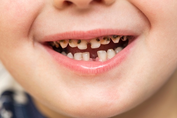 Cavity Treatment For Kids: Things Parents Should Know