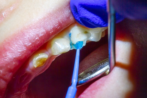 How Dental Sealants Prevent Cavities In Kids